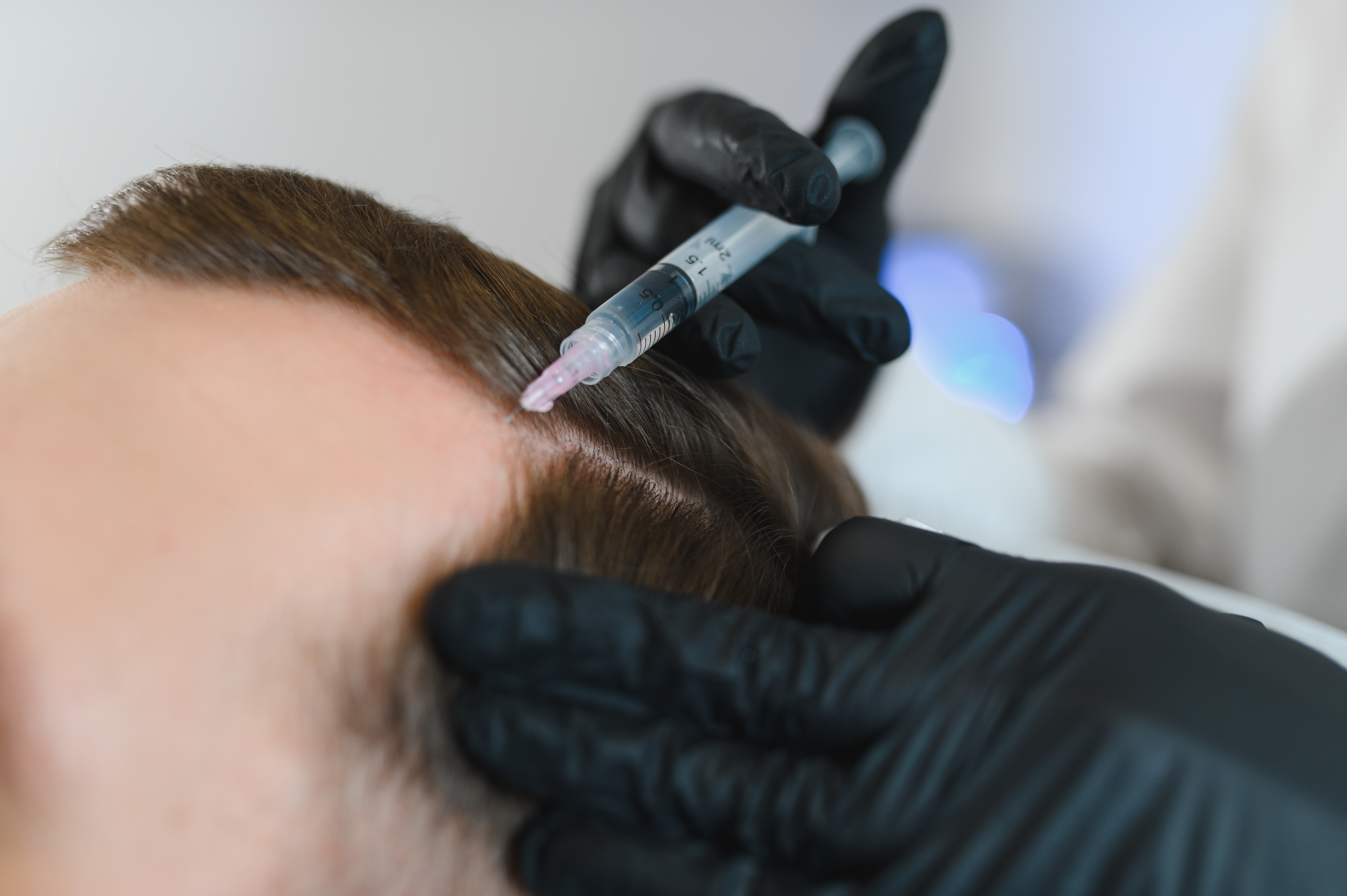 Mesoterapia capilar: evidencia, beneficios y quién realmente es candidato ideal